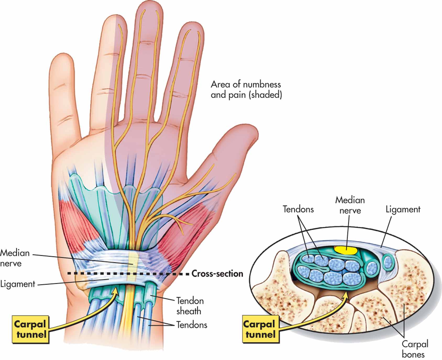 CarpalTunnelGoodDiagram